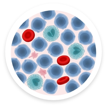 Illustration of blood count with AML